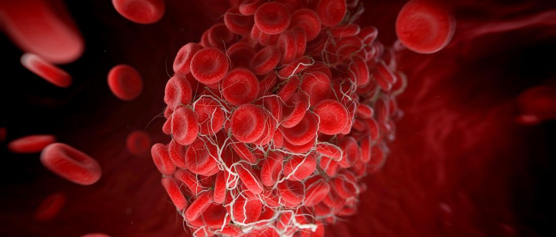 Hemophilia