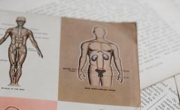 Ulcerative Colitis